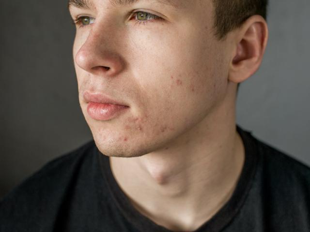 Boy with acne looking to the side