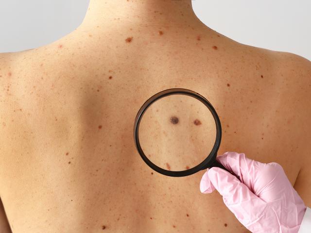 Hand of dermatologist holding magnifying glass, examining moles on the back of a patient