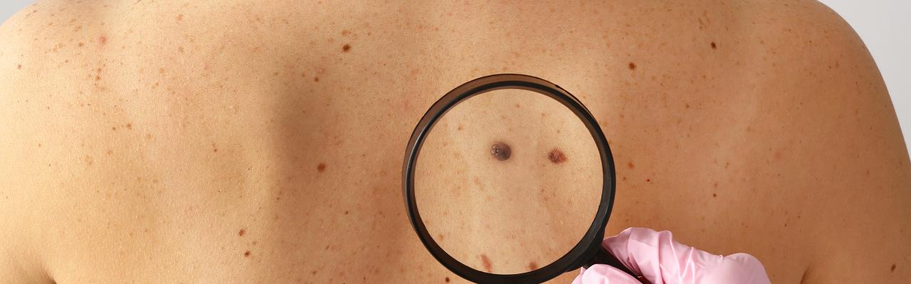 Hand of dermatologist holding magnifying glass, examining moles on the back of a patient