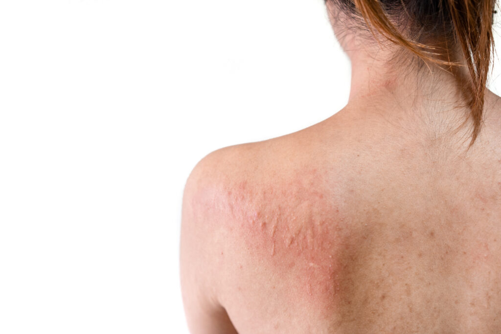 Rash on back