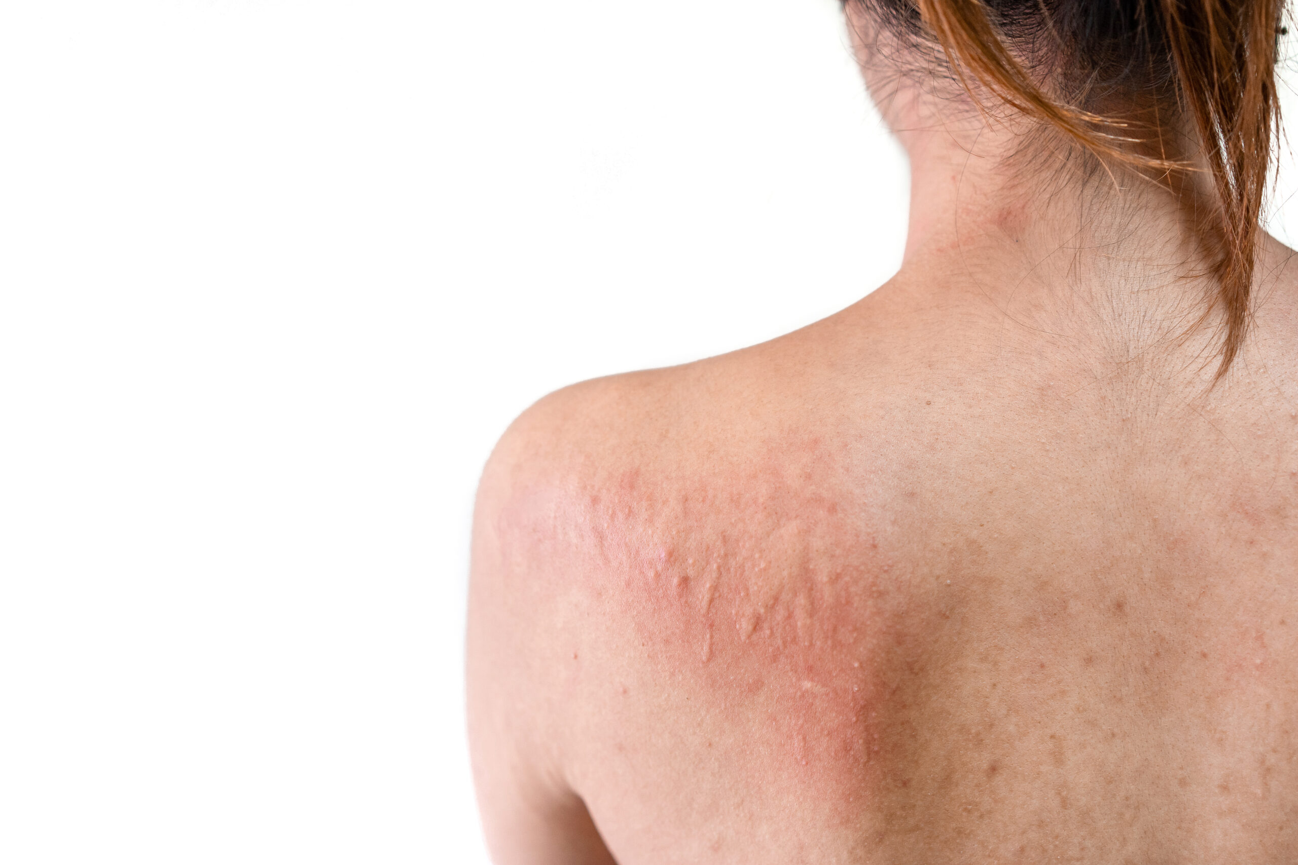 Rash on back