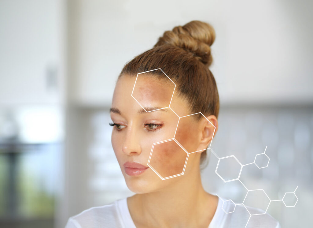 Melasma