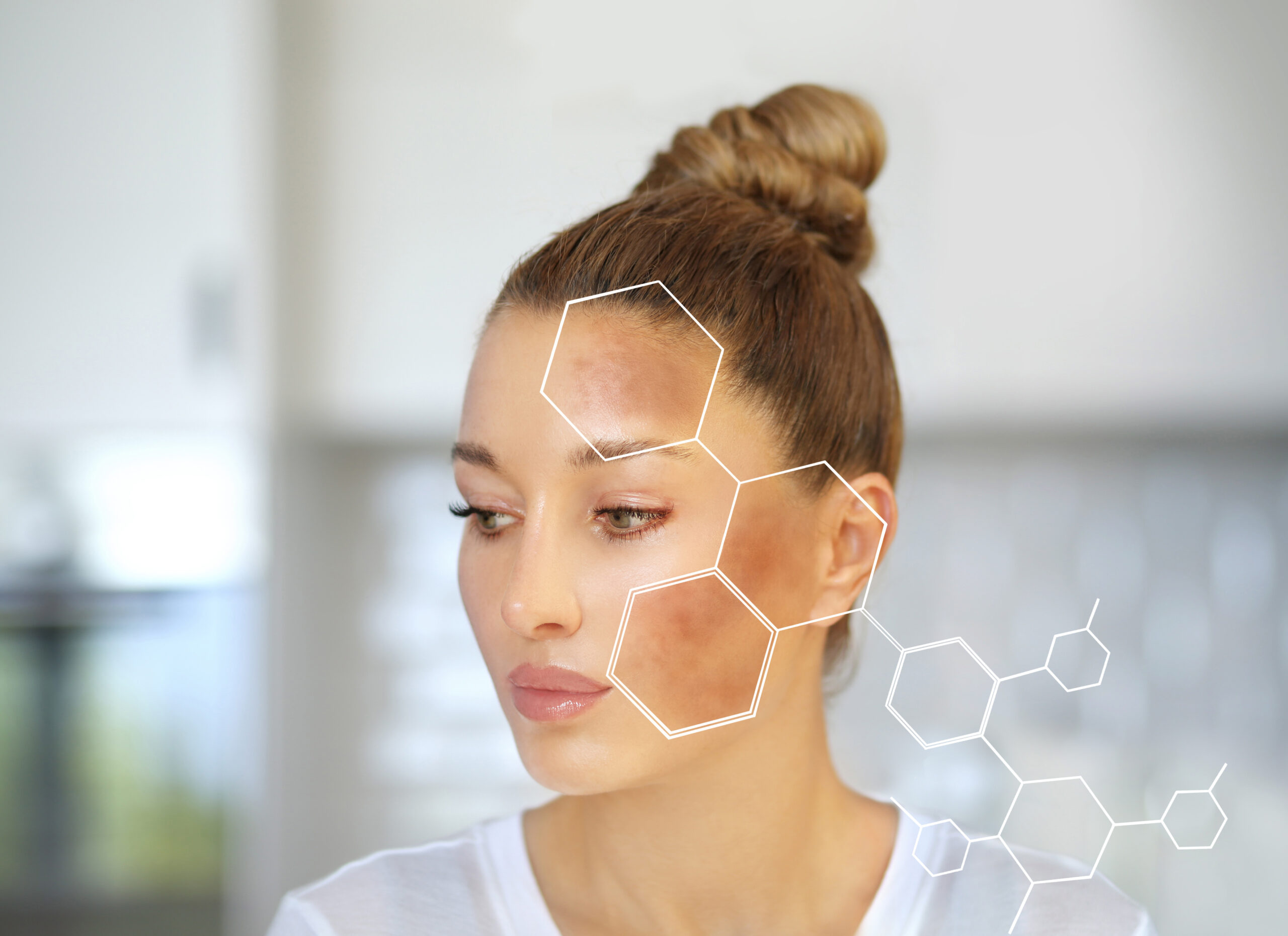 Melasma
