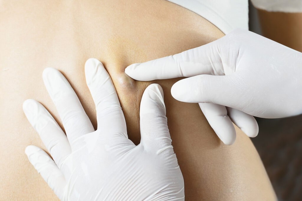 Cysts and Other Bumps