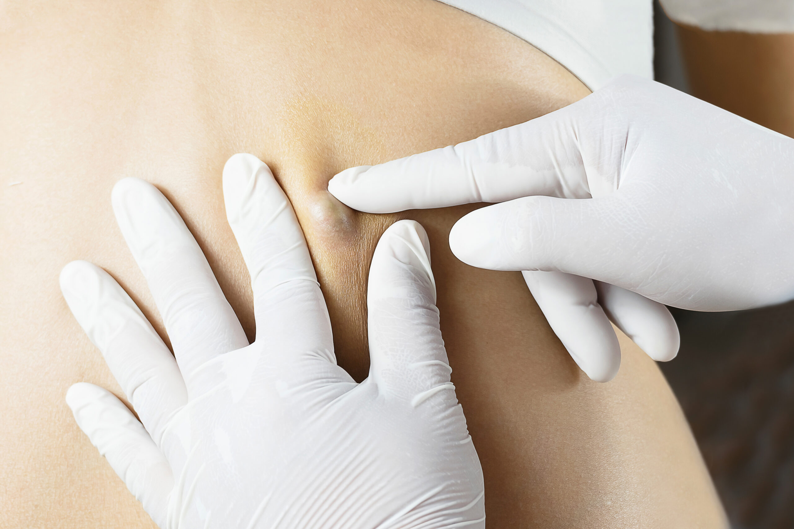 Cysts and Other Bumps