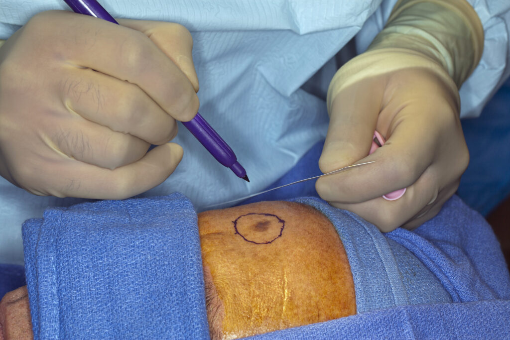 Skin Cancer Surgeries