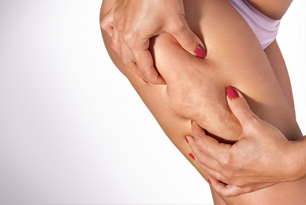 Reducing Cellulite