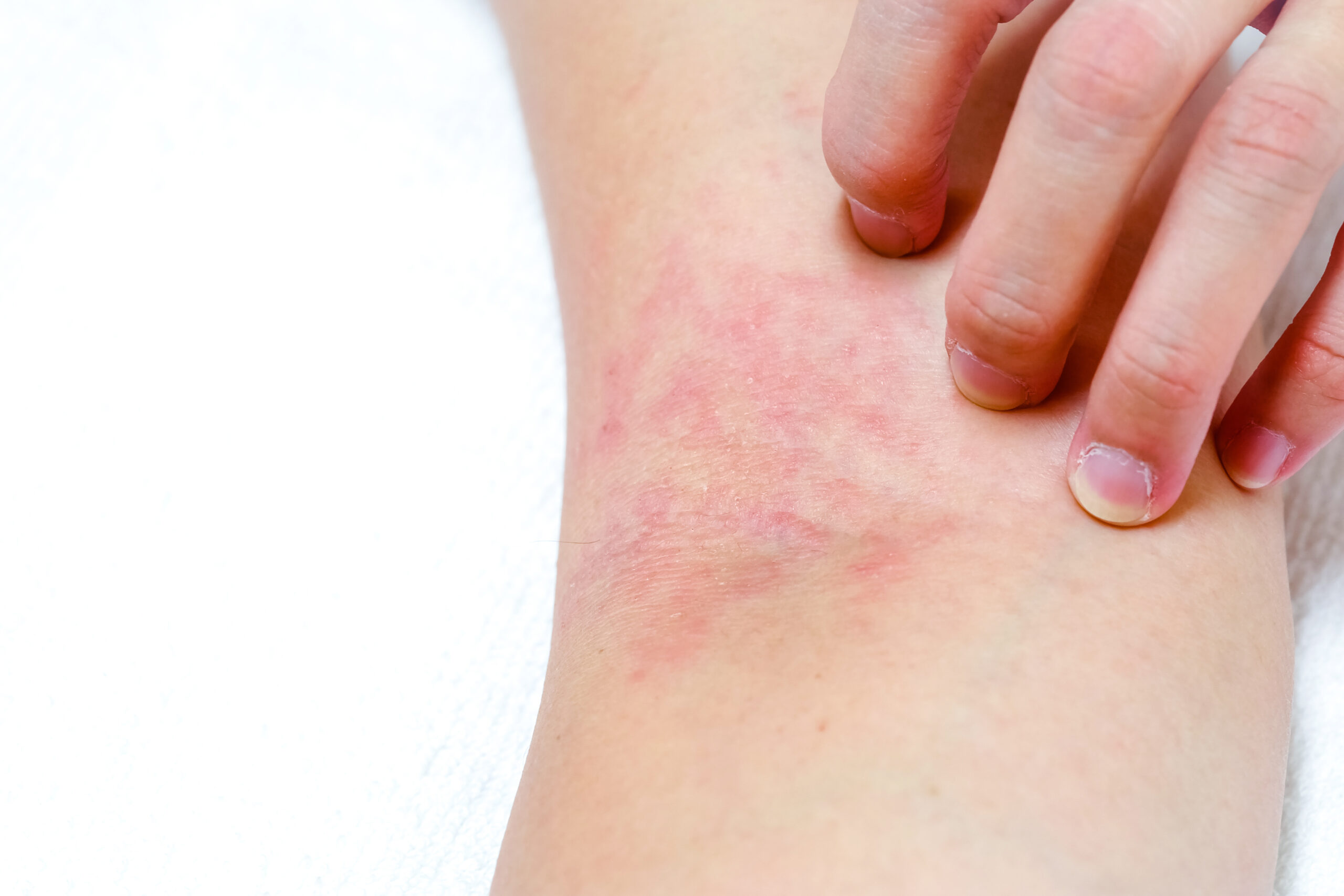 Eczema on arm