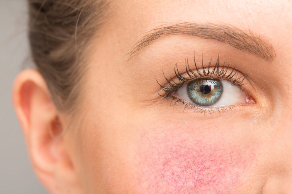 Close-up of woman with rosacea on cheek