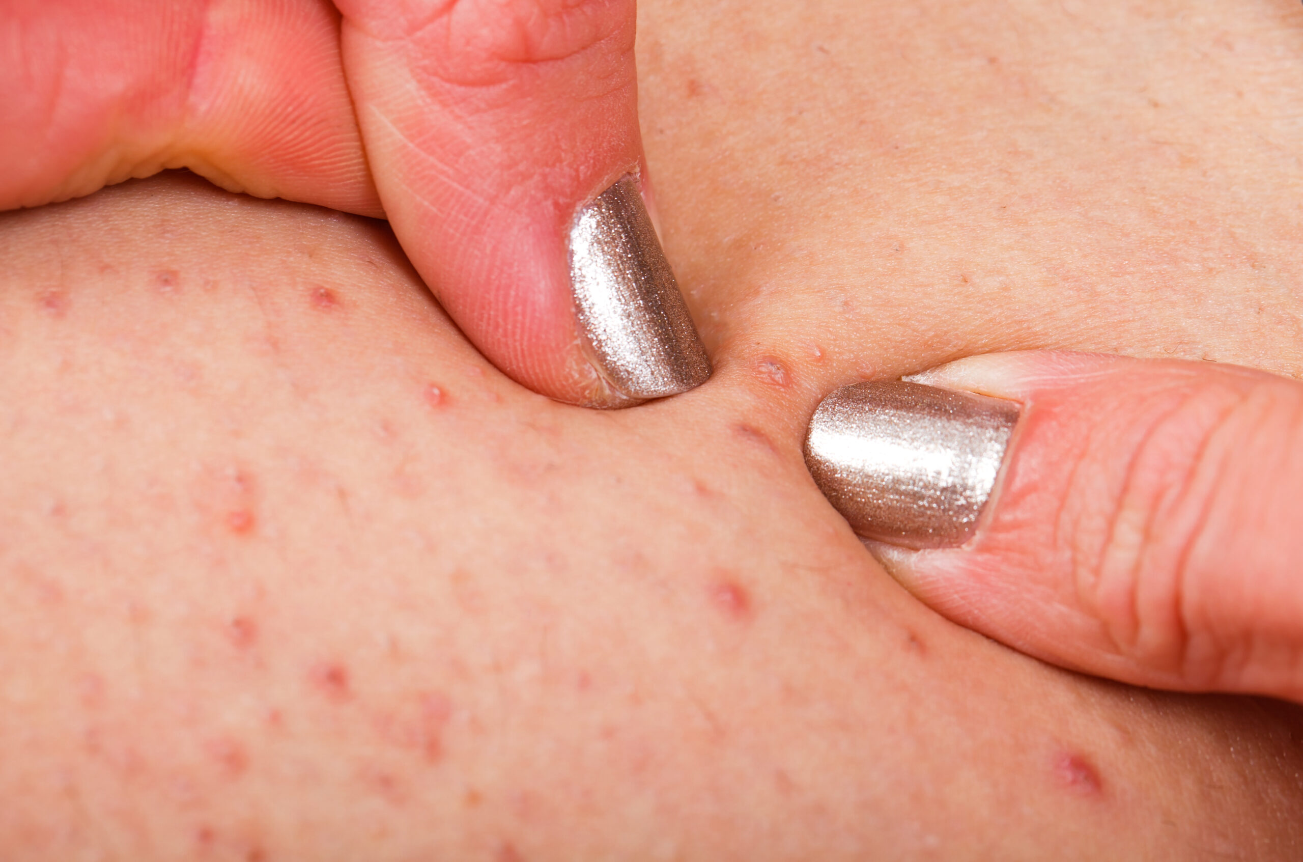 Woman squeezing Razor Bumps