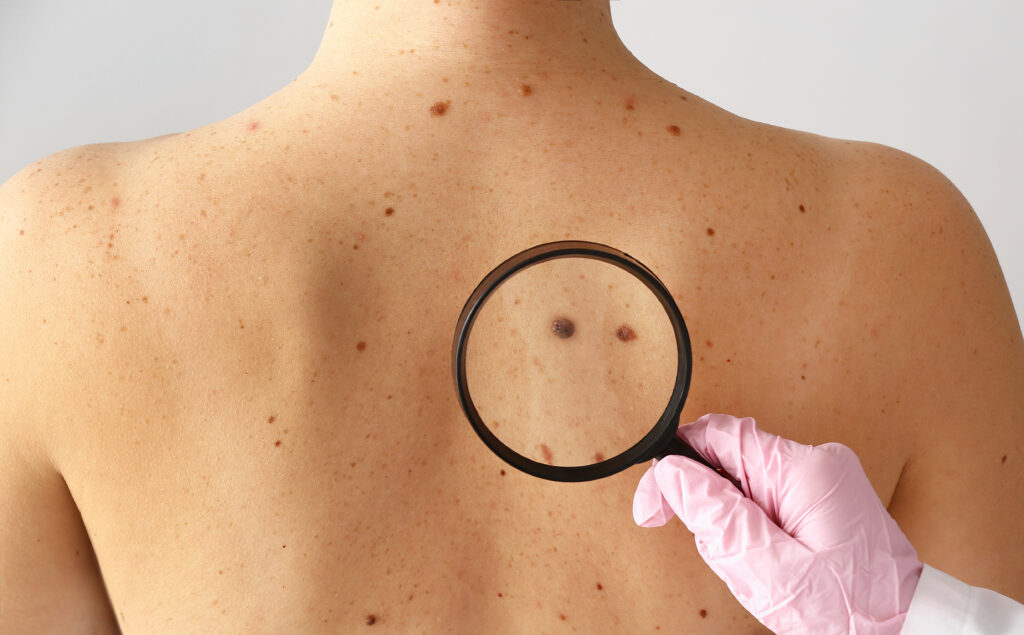 Hand of dermatologist holding magnifying glass, examining moles on the back of a patient