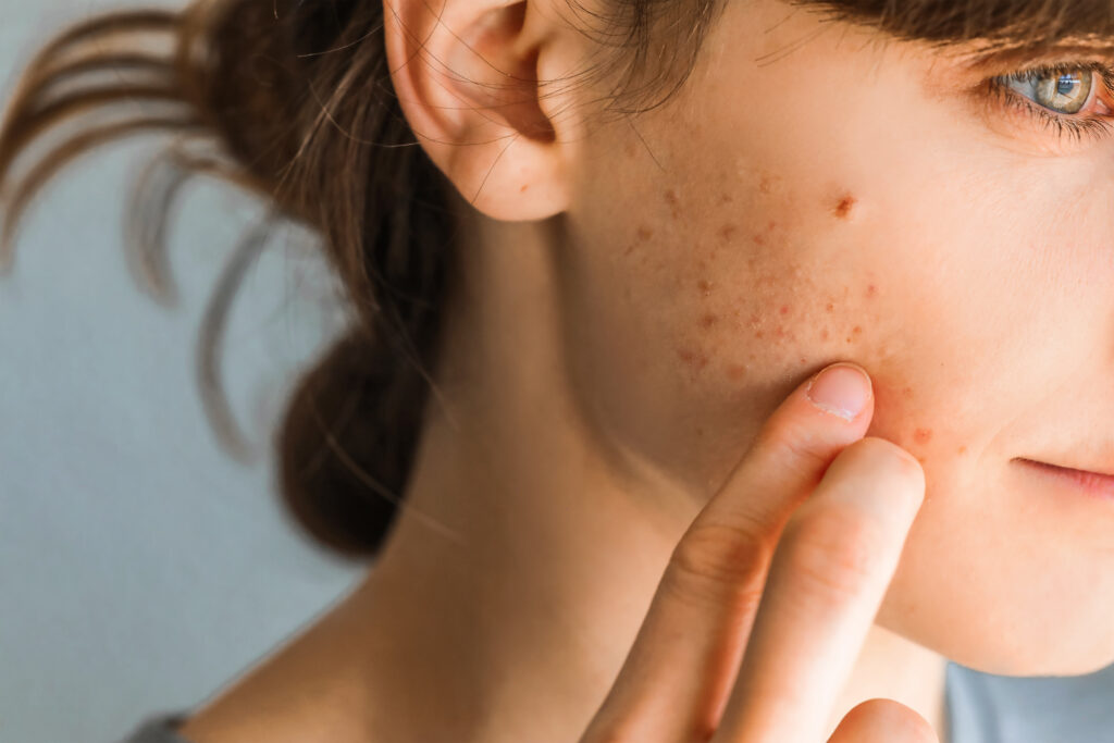 Woman with acne