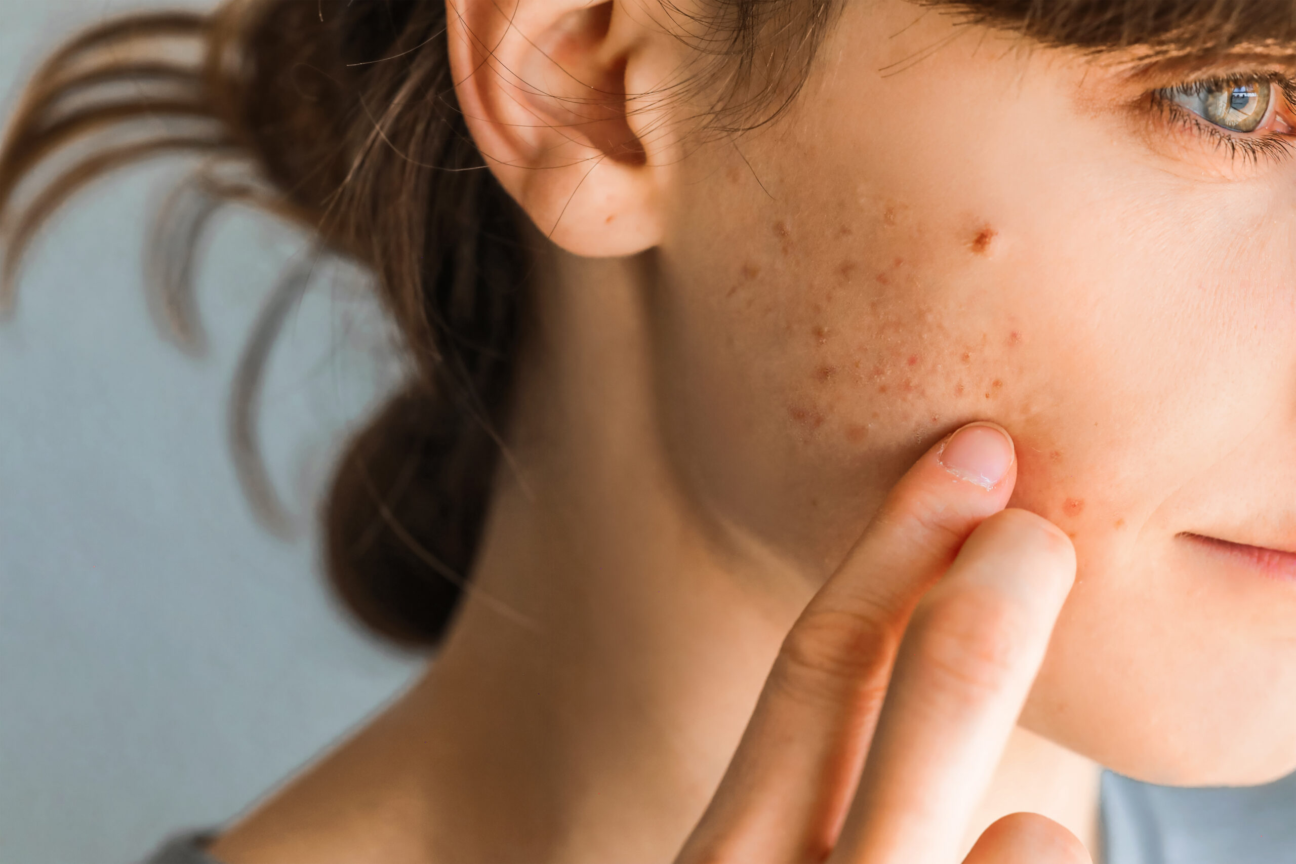 Woman with acne